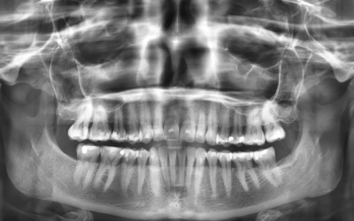Må jeg ta OPG (panorama-røntgenbilde) hos tannlegen?
