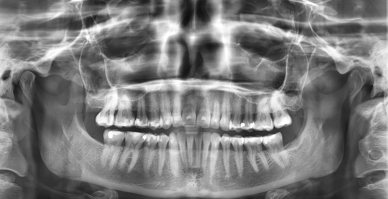 OPG panoramarontgenbilde tannkontoret
