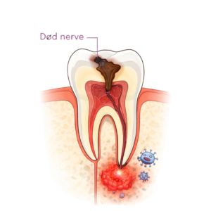 død tannnerve
